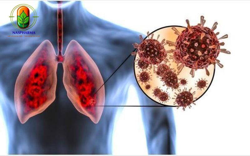Triệu Chứng Viêm Phổi Ở Người Cao Tuổi