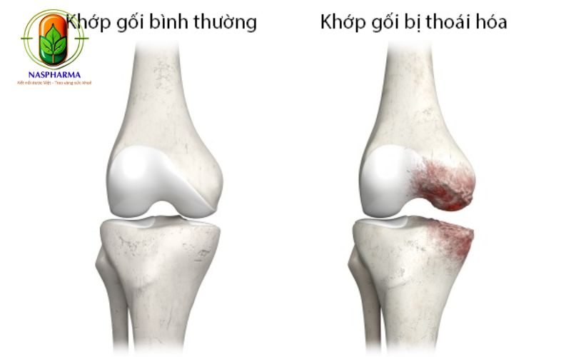Cách Điều Trị Thoái Hóa Khớp Hiệu Quả