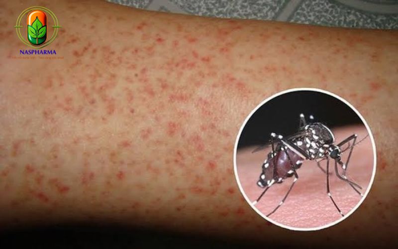 Bệnh Sốt Xuất Huyết Là Gì?