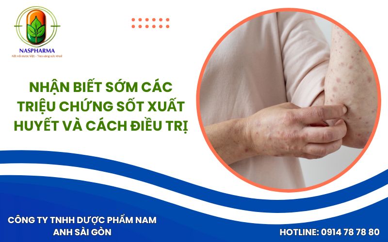 Nhận Biết Sớm Các Triệu Chứng Sốt Xuất Huyết Và Cách Điều Trị